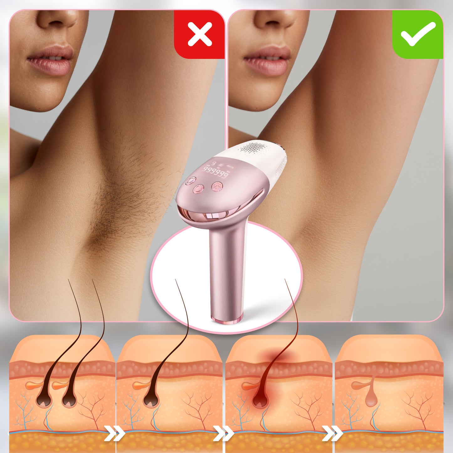Depilator IPL FitbyMed®